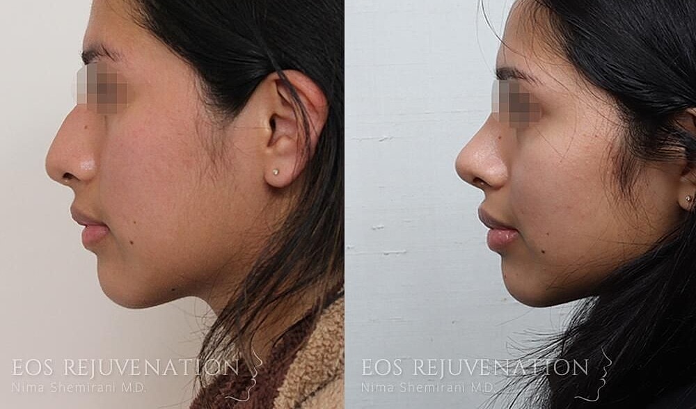 Rhinoplasty Before & After