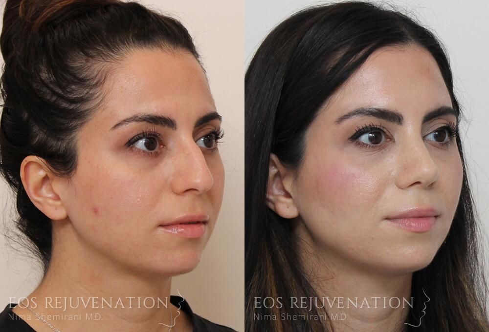 Rhinoplasty Before & After