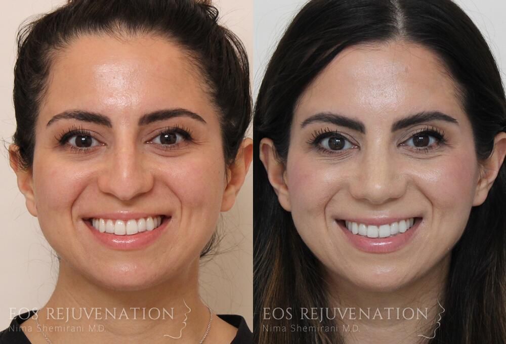 Rhinoplasty Before & After