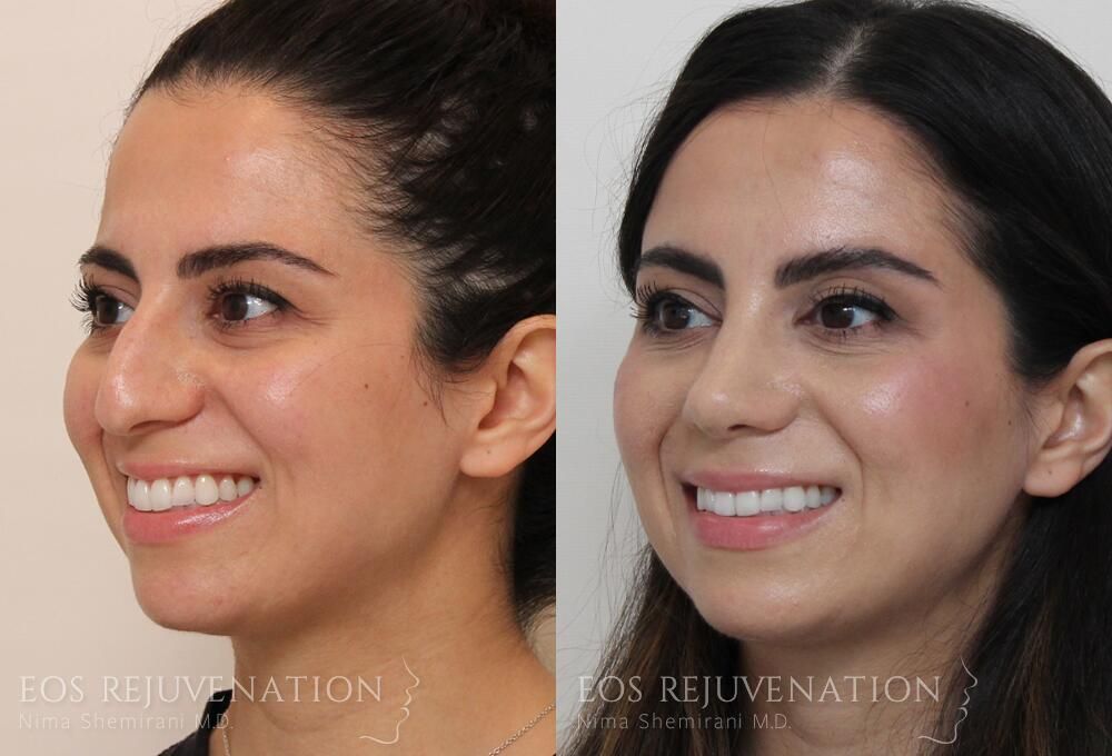 Rhinoplasty Before & After