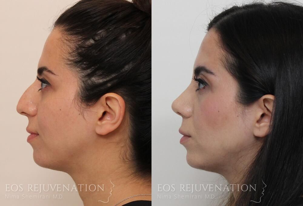 Rhinoplasty Before & After