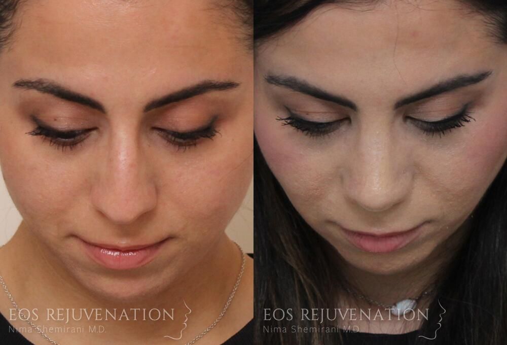 Rhinoplasty Before & After