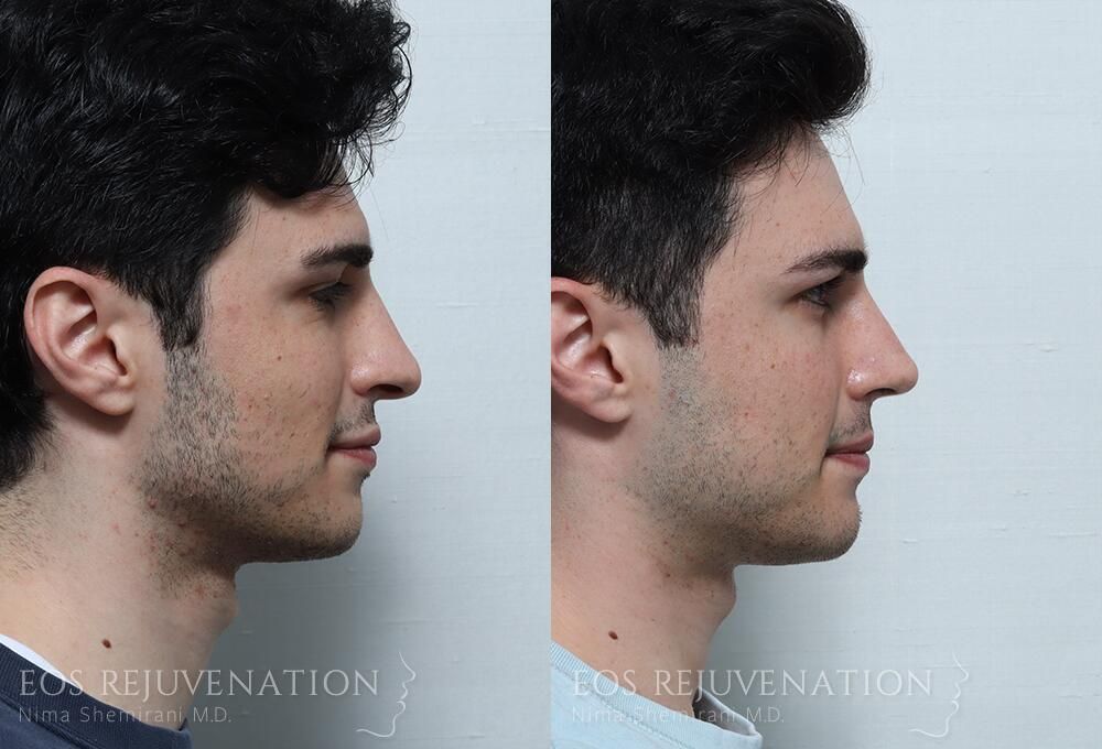 Rhinoplasty Before & After