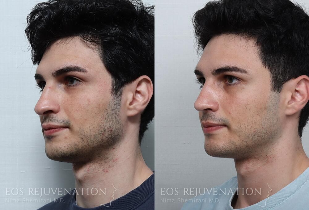 Rhinoplasty Before & After