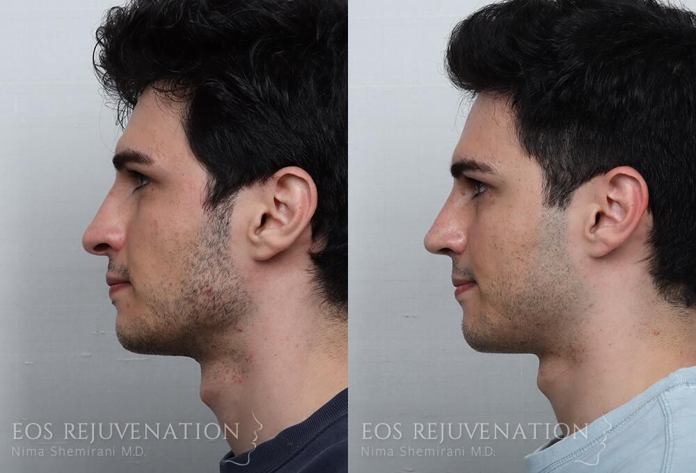 Rhinoplasty Before & After