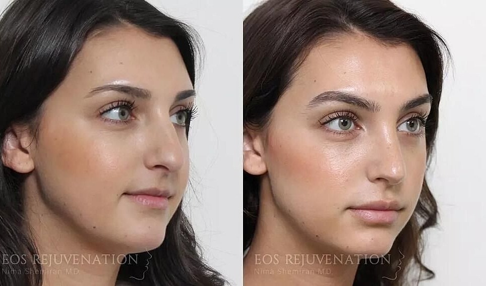 Rhinoplasty Before & After