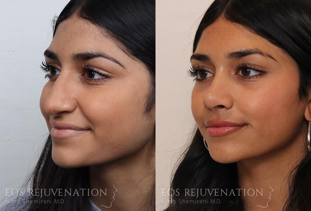 Rhinoplasty Before & After