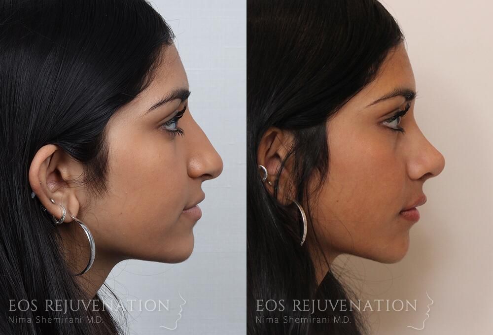 Rhinoplasty Before & After