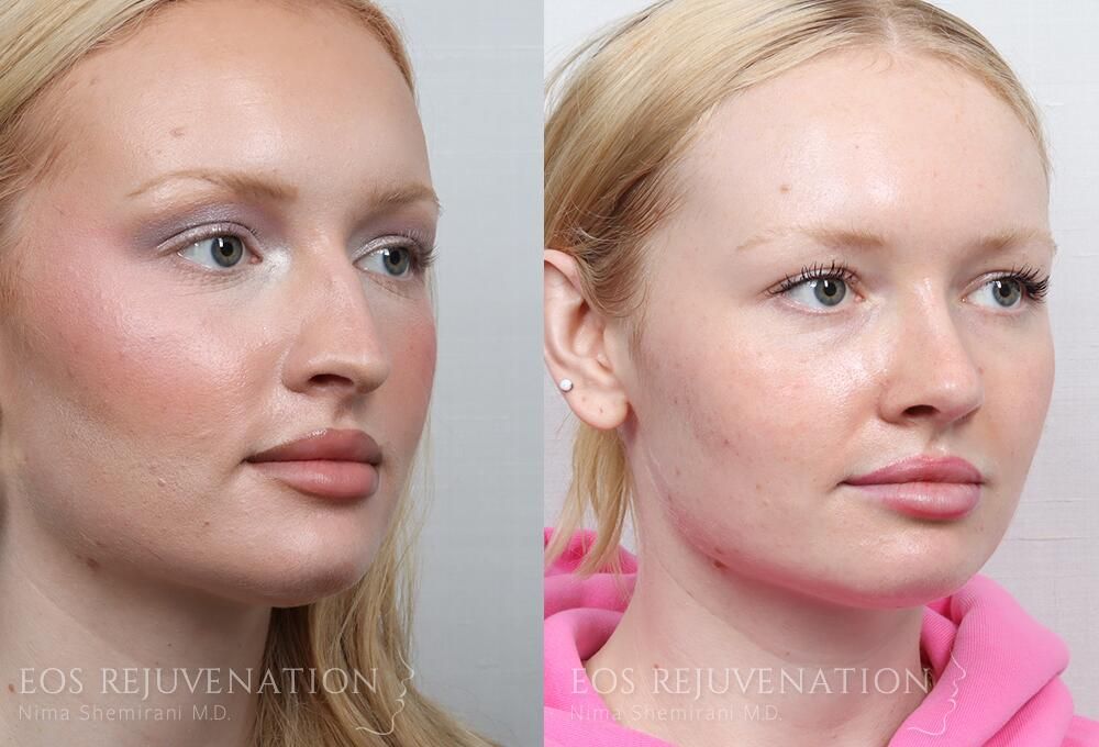Rhinoplasty Before & After