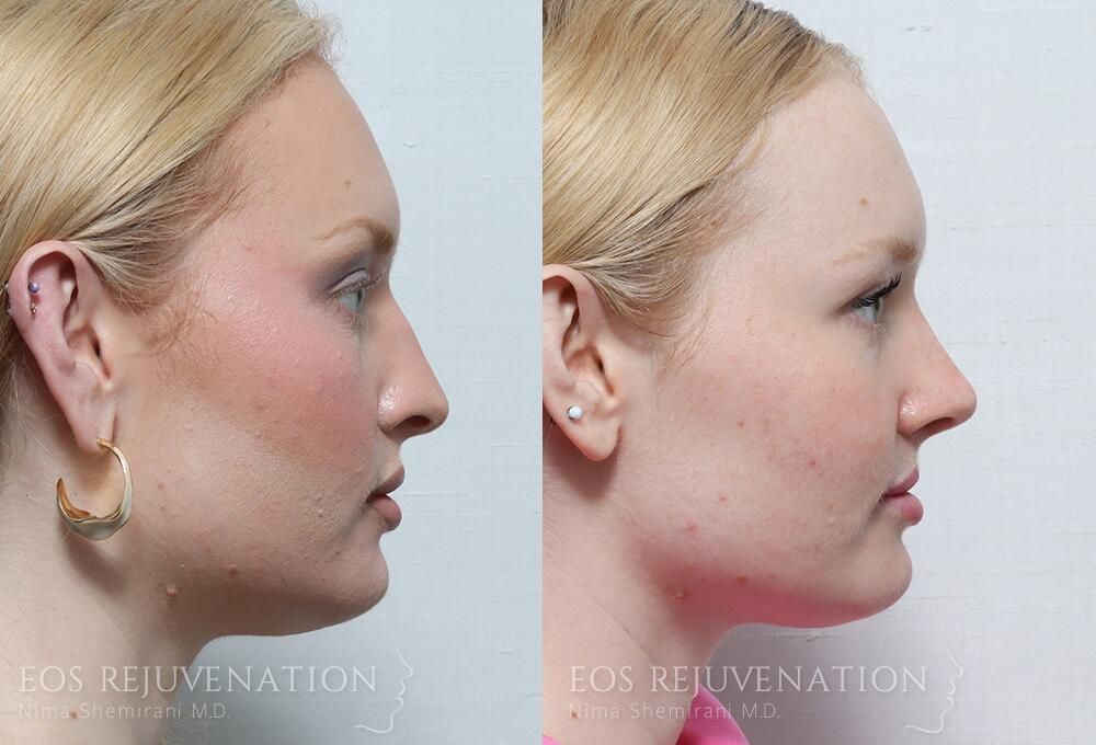 Rhinoplasty Before & After