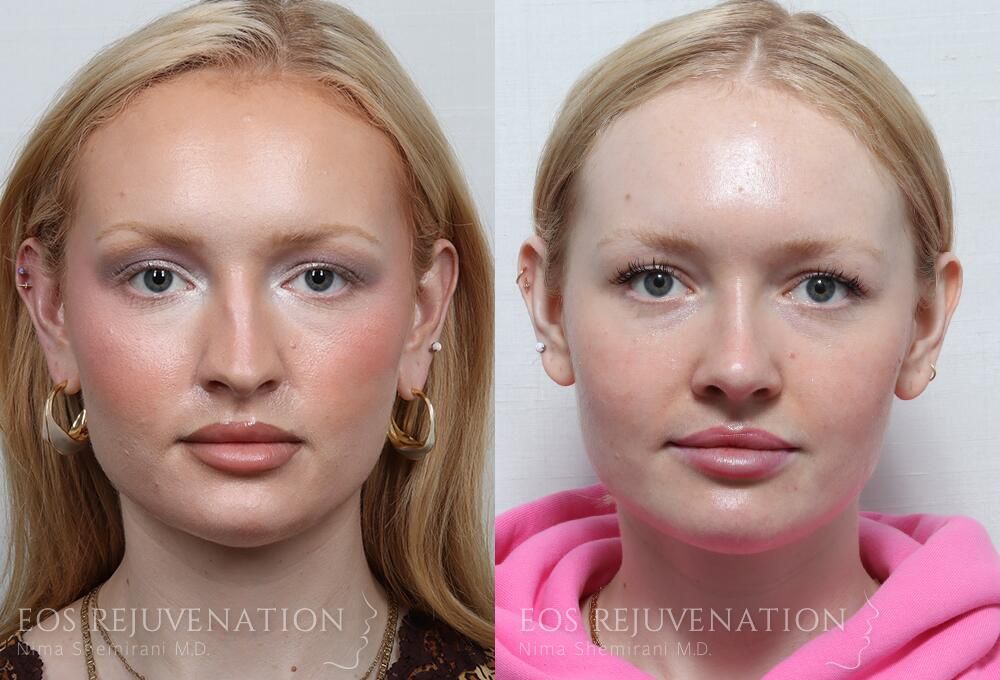 Rhinoplasty Before & After