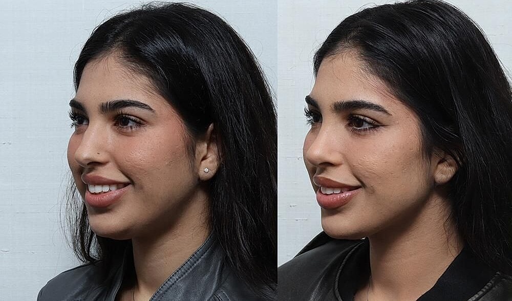 Rhinoplasty Before & After