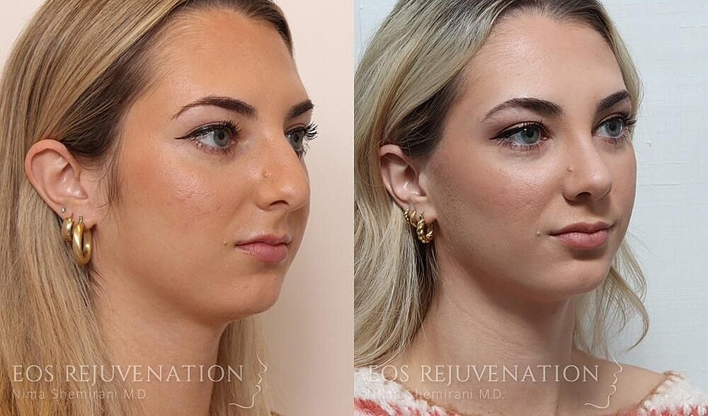 Rhinoplasty Before & After