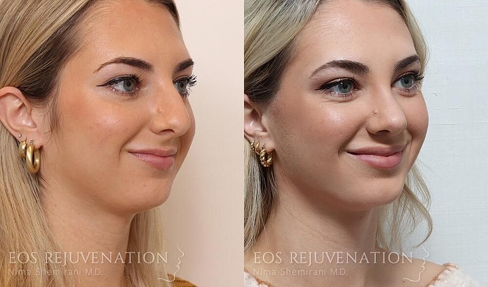 Rhinoplasty Before & After