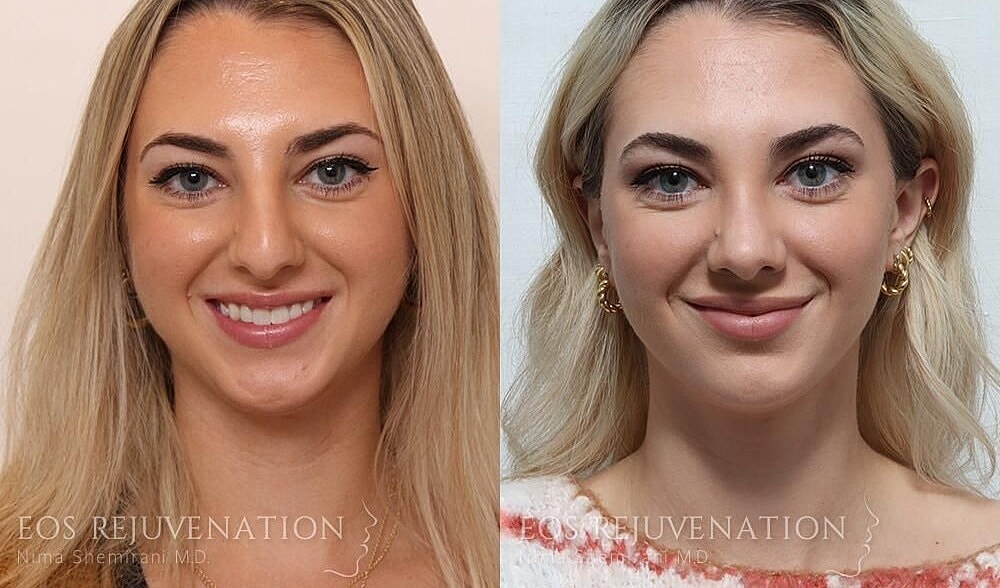 Rhinoplasty Before & After