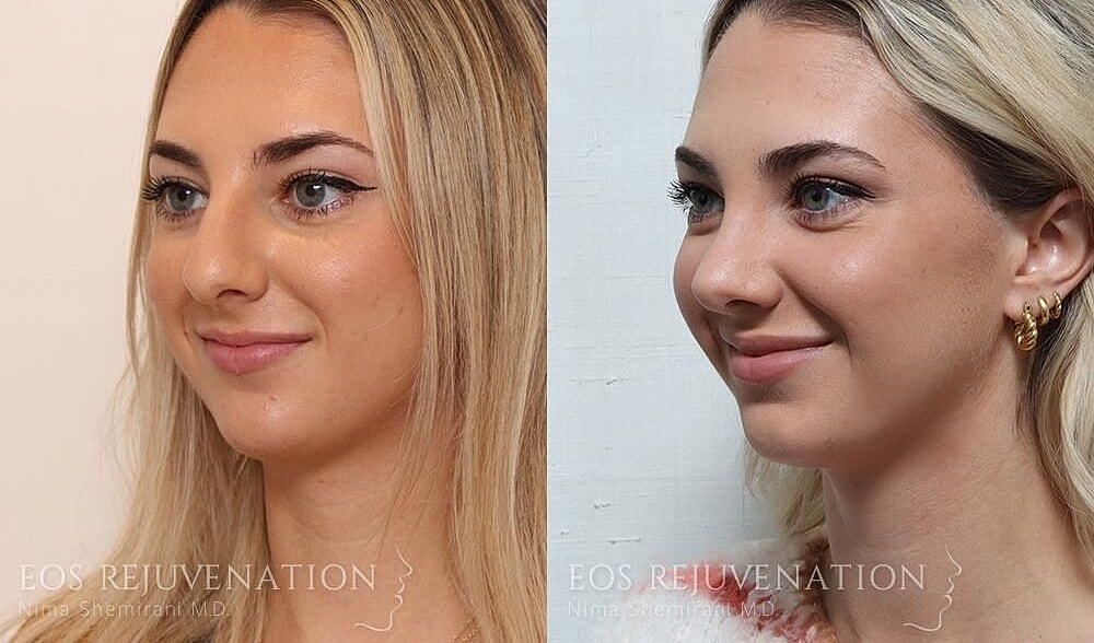 Rhinoplasty Before & After