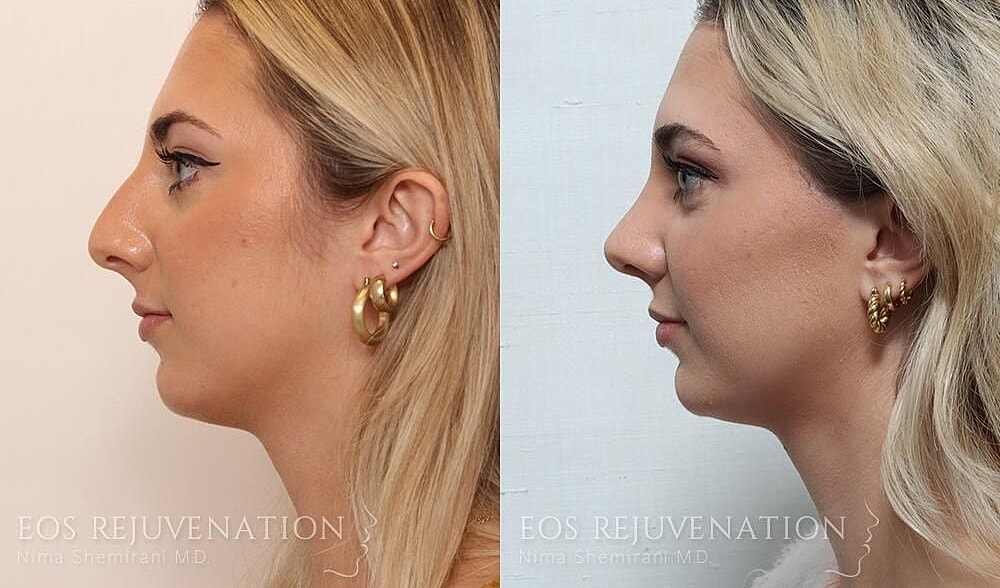 Rhinoplasty Before & After