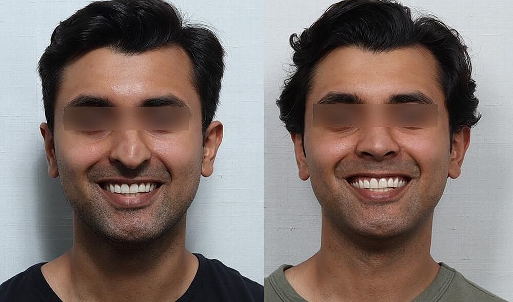 Rhinoplasty Before & After