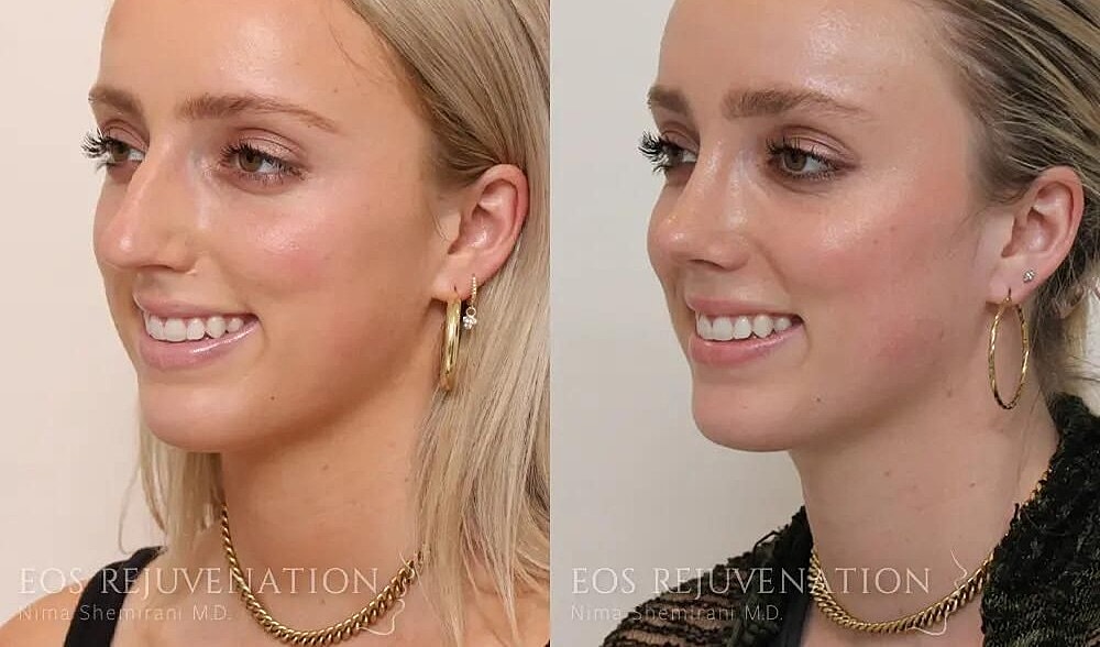 Rhinoplasty Before & After