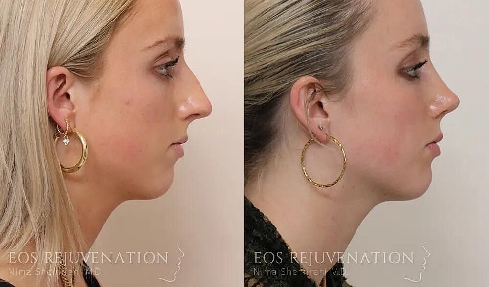 Rhinoplasty Before & After