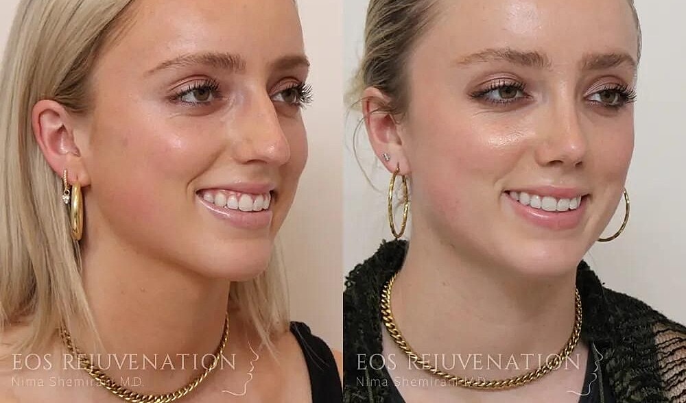 Rhinoplasty Before & After