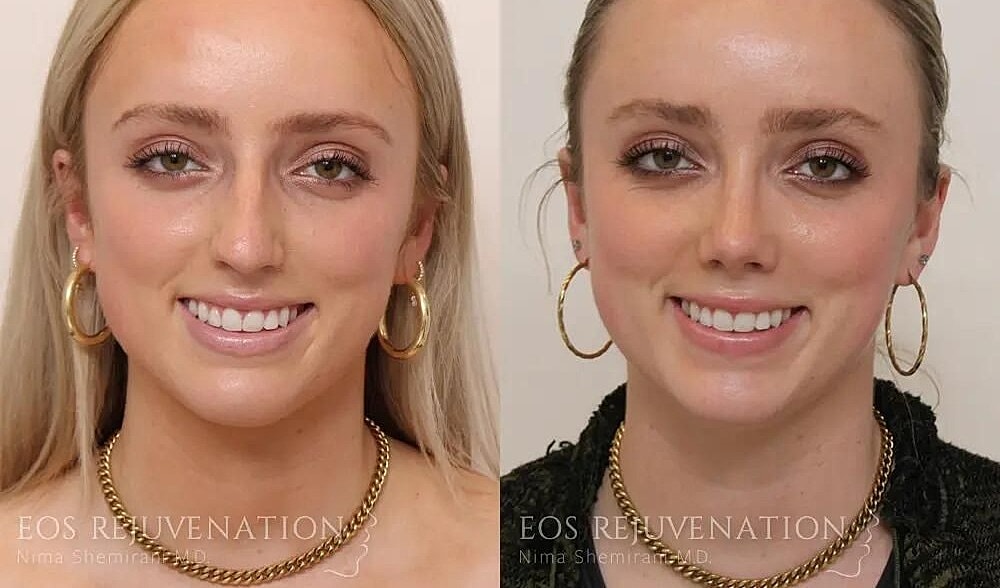 Rhinoplasty Before & After
