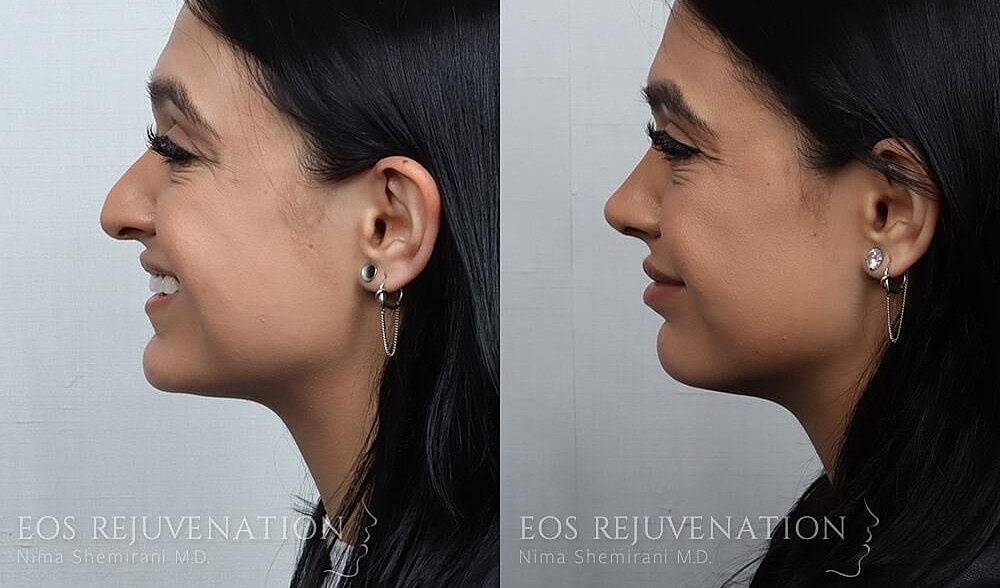Rhinoplasty Before & After