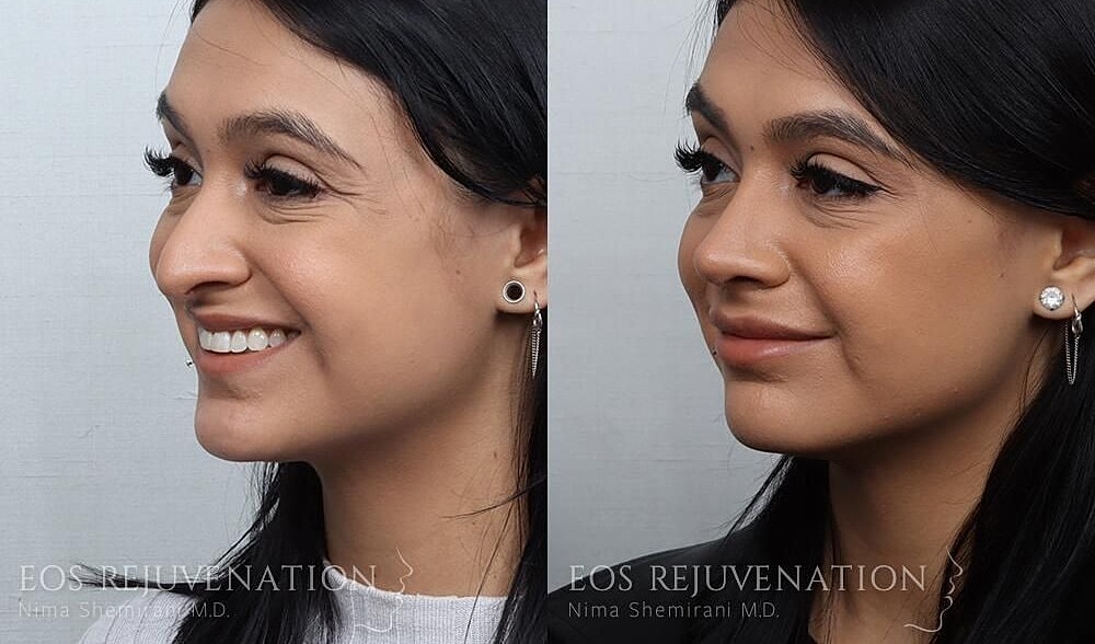 Rhinoplasty Before & After