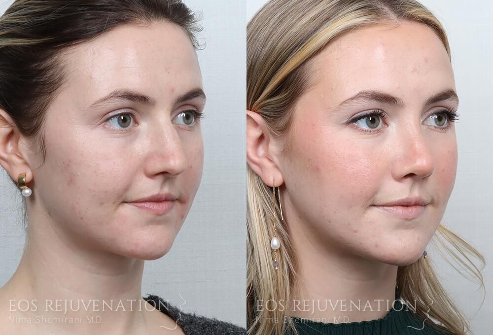 Rhinoplasty Before & After