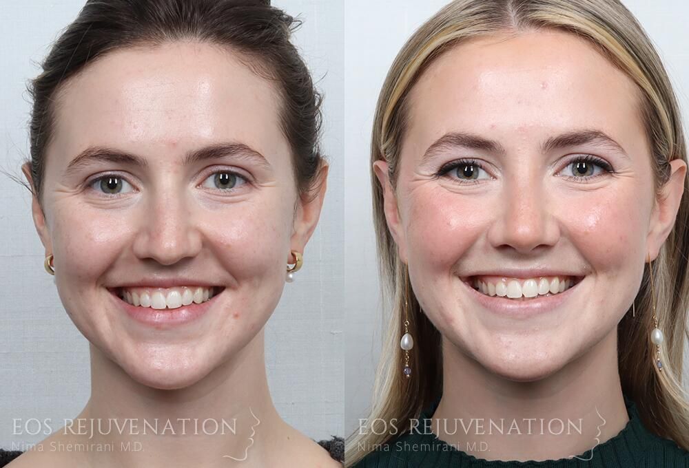Rhinoplasty Before & After