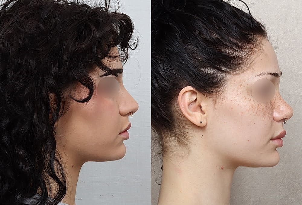 Side profile comparison of two women.