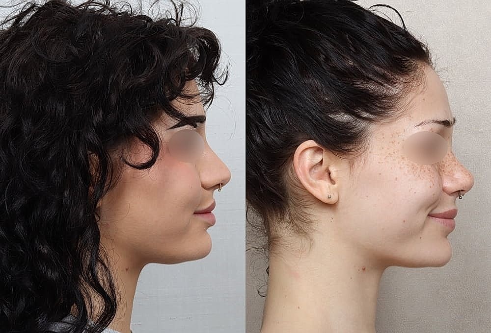 Before and after facial transformation comparison.