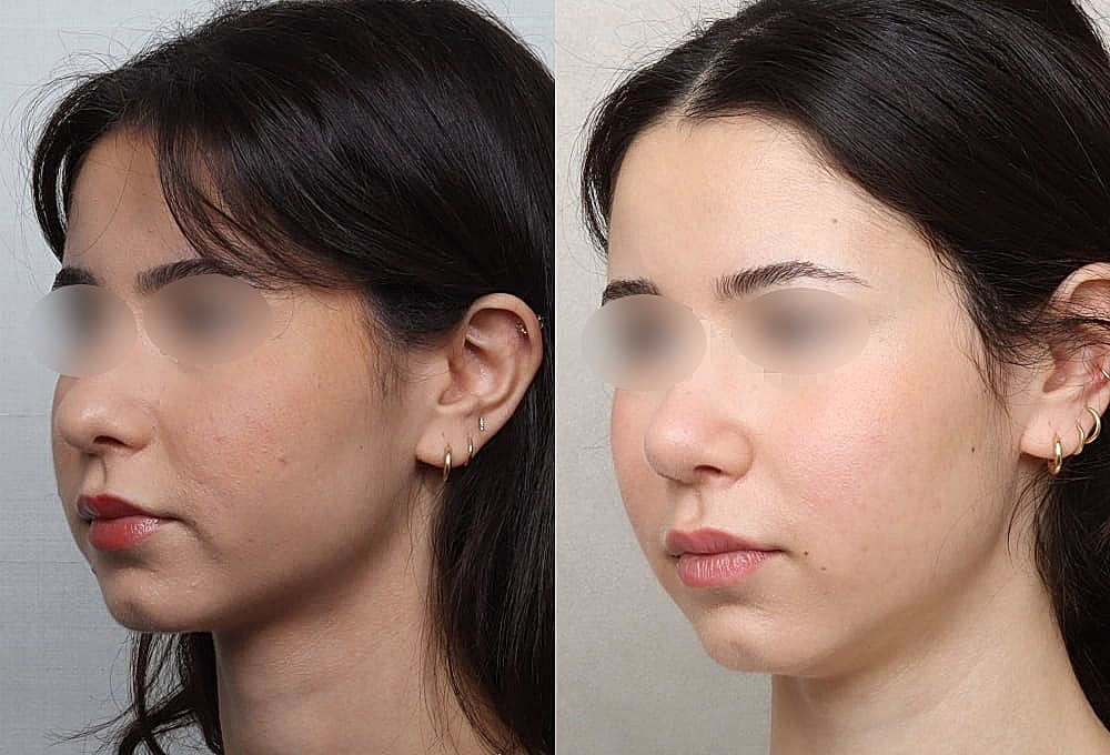 Before and after facial profile comparison.