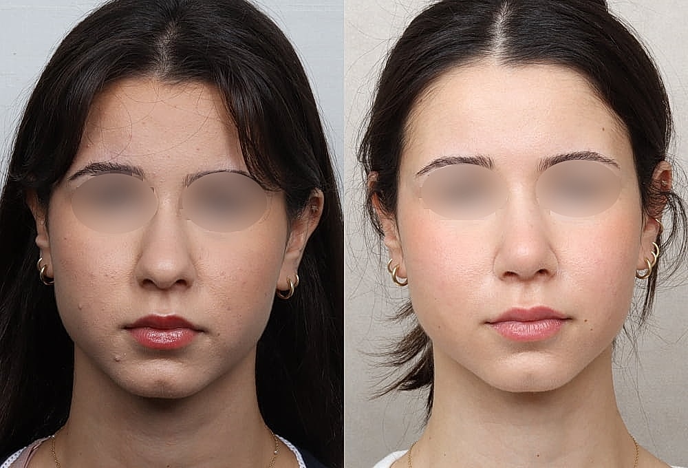 Before and after facial transformation comparison.
