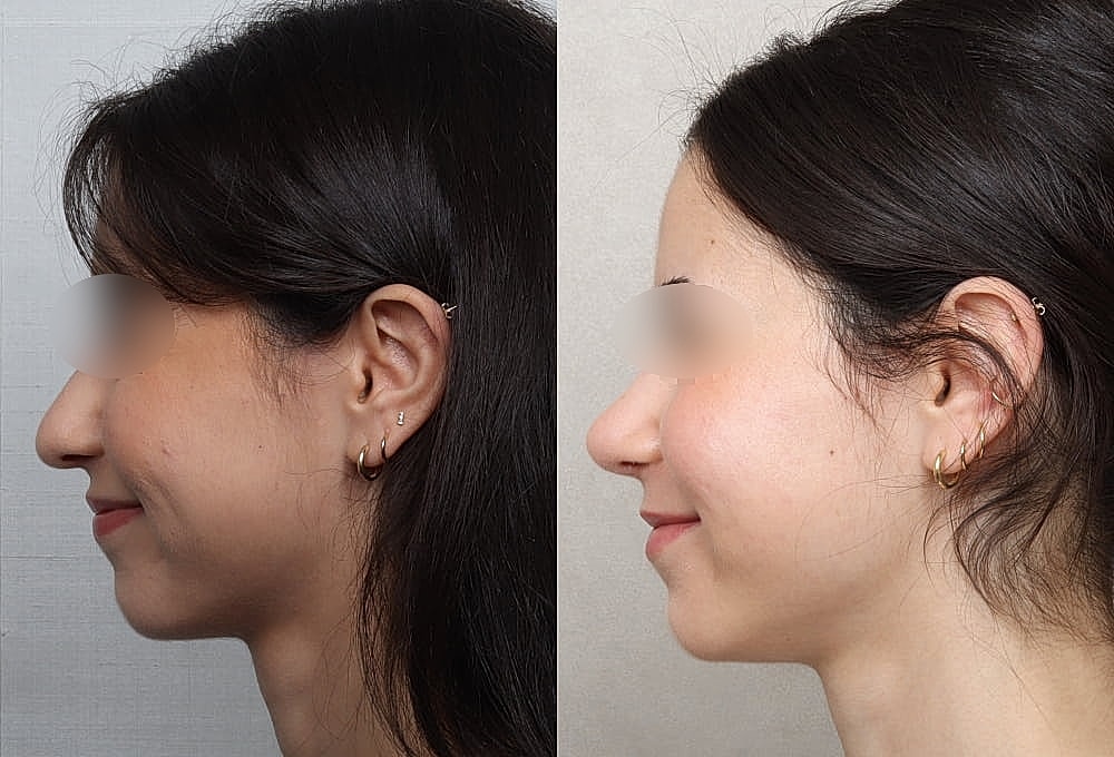 Before and after profile comparison of a woman.