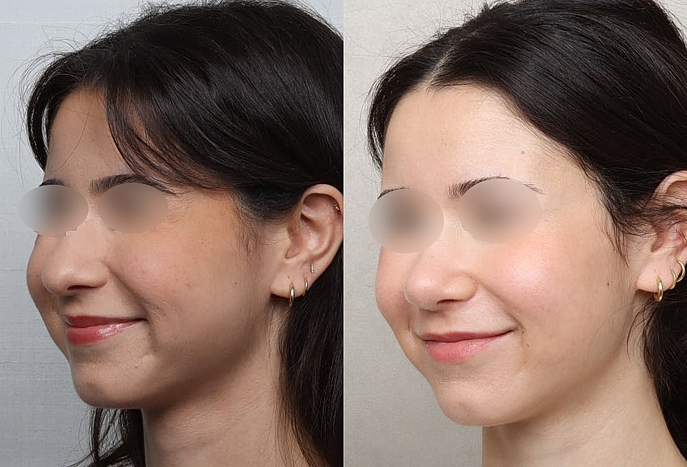 Before and after cosmetic facial treatment images.