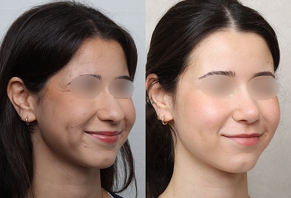Before and after facial aesthetic improvement.