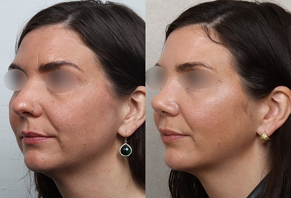 Before and after side profile images of a woman