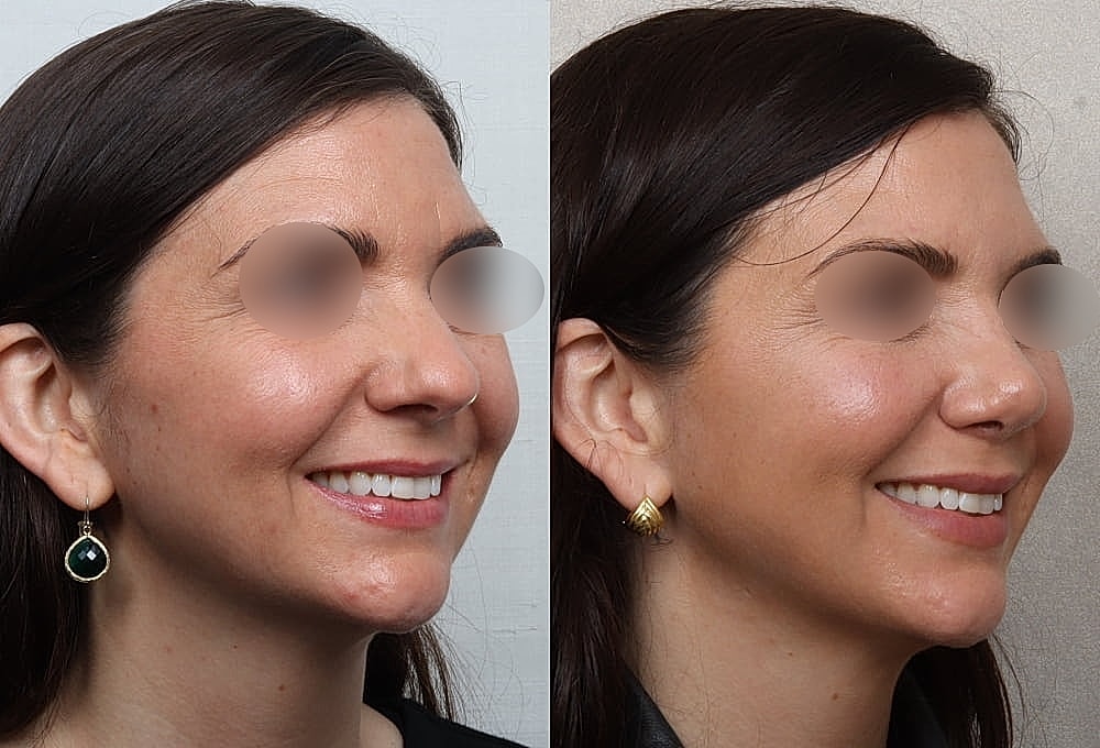 Before and after facial comparison image.