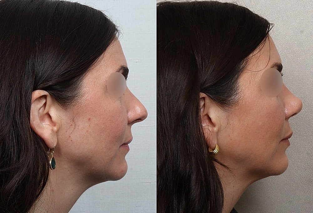 Before and after profile comparison of a woman.