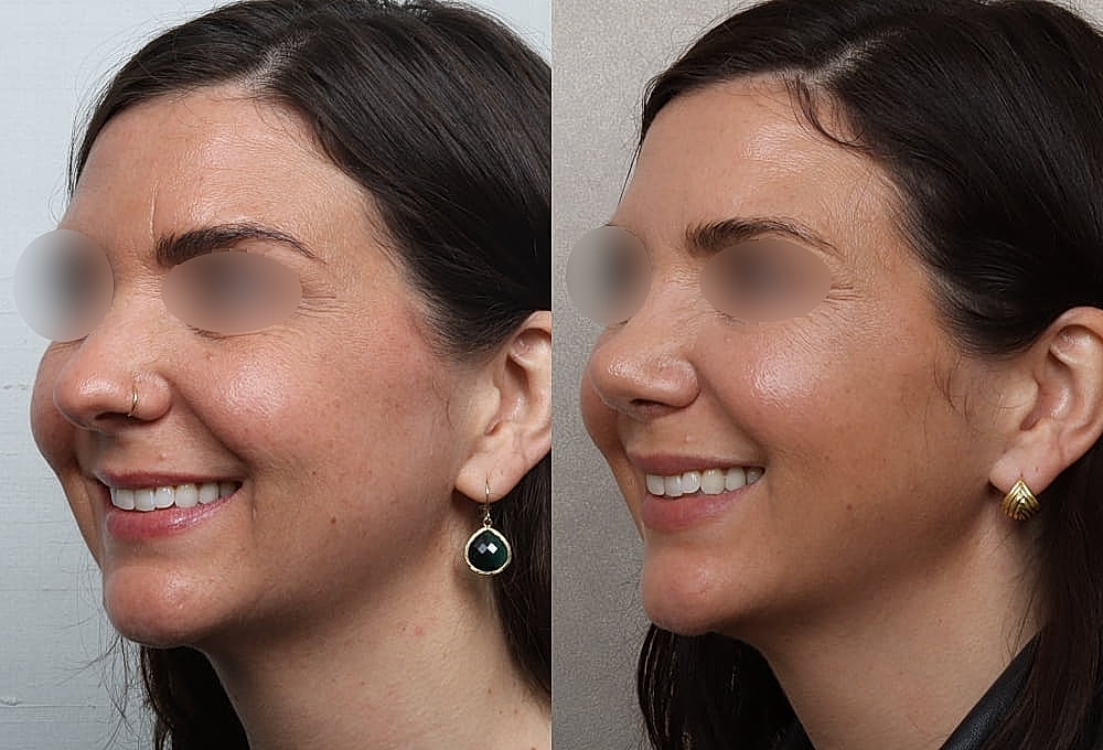 Before and after profile comparison of smiling woman
