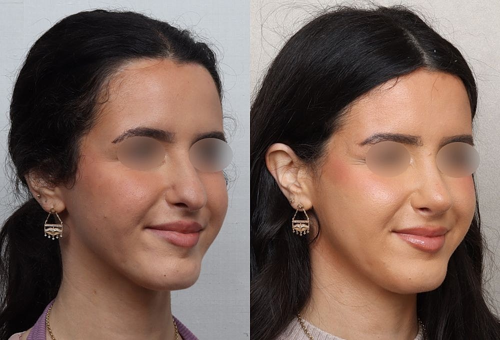 Before and after portrait comparison of woman.