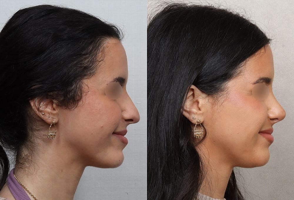 Comparison of two side profile portraits.