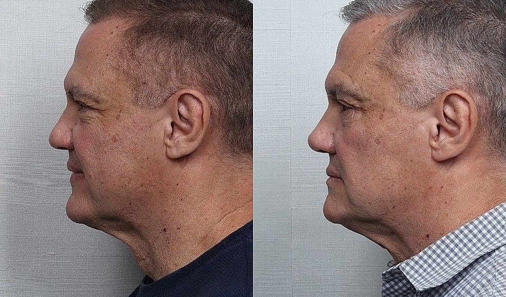 Rhinoplasty Before & After