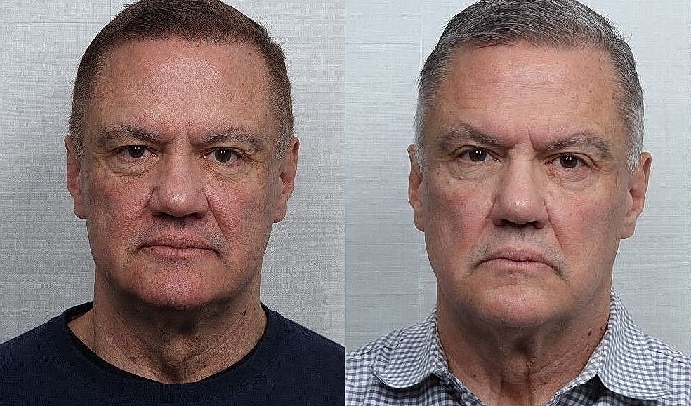 Rhinoplasty Before & After