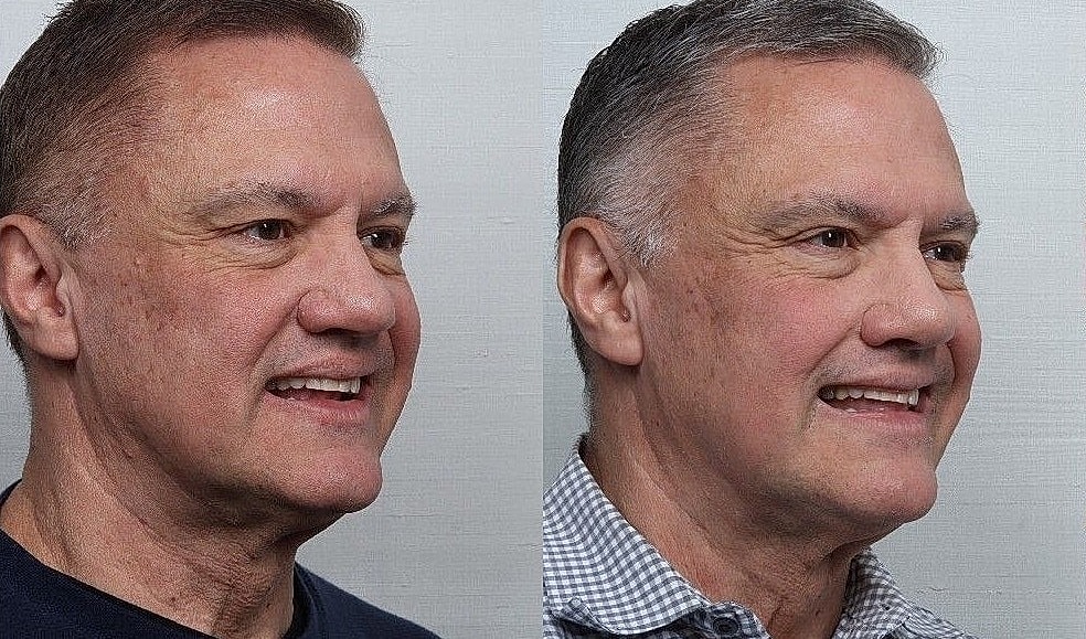 Rhinoplasty Before & After