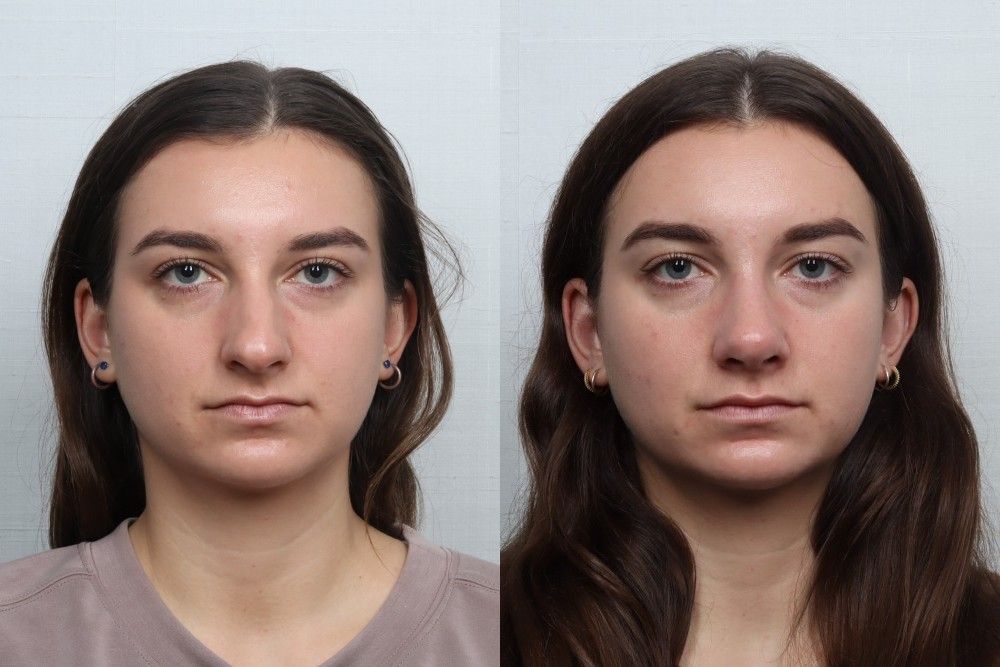 Rhinoplasty Before & After