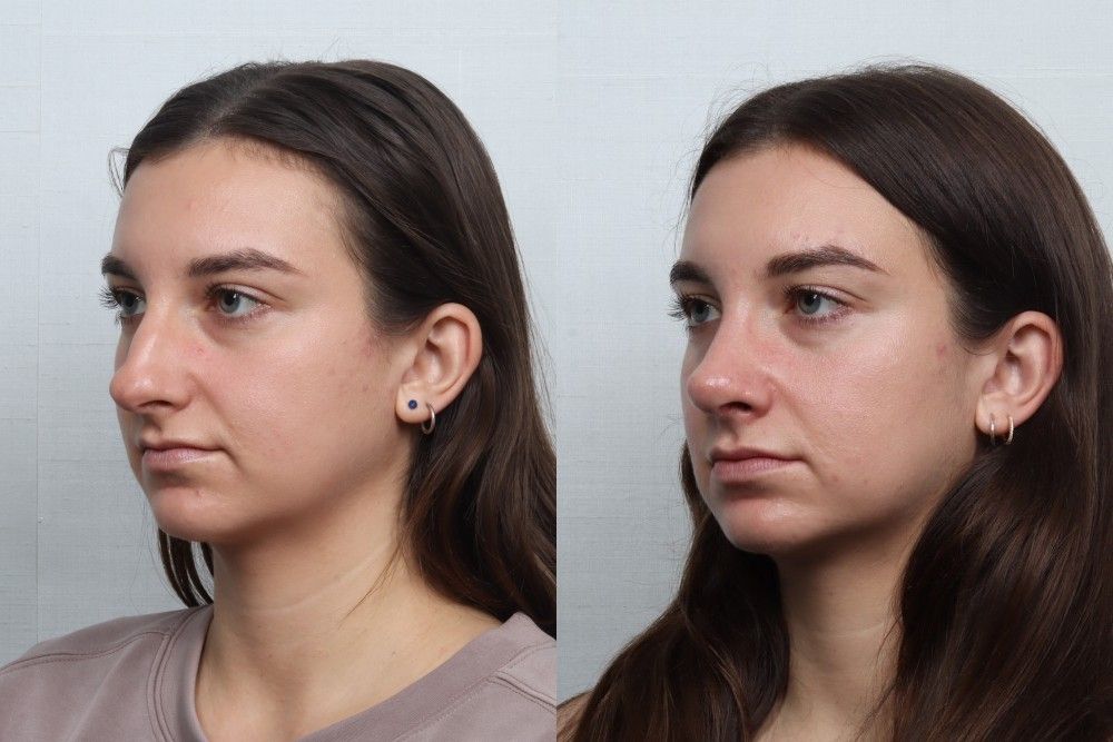 Rhinoplasty Before & After