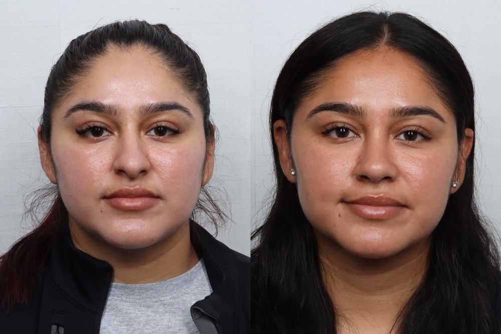 Rhinoplasty Before & After