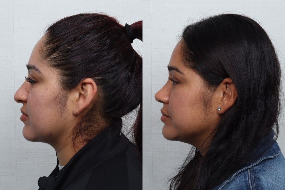 Rhinoplasty Before & After